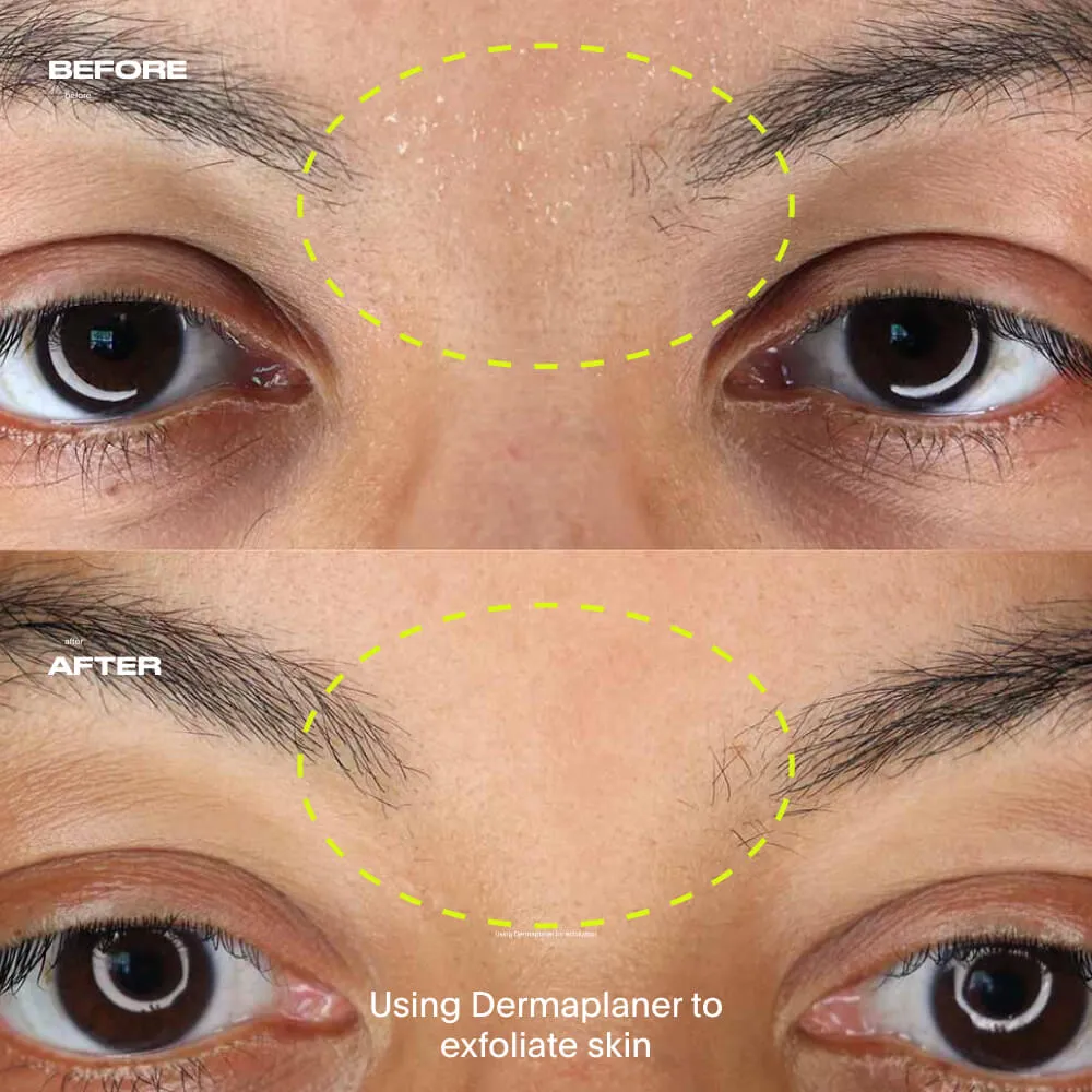 Dermaplaner